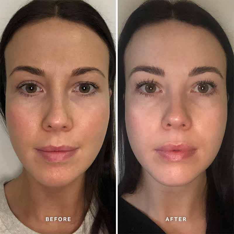 Alpha-H Vitamin B Serum with 5% Niacinamide | before and after using vitamin b serum for 4 weeks 