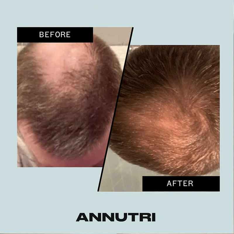 Annutri Grow It Hair Supplement, Mens thinning hair, hair loss in men