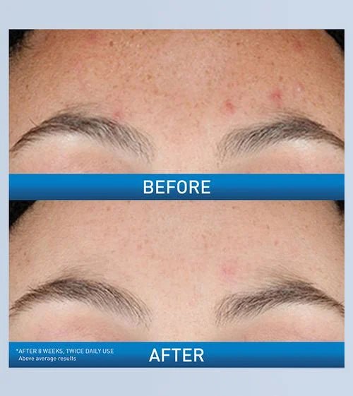 CeraVe, before and after treatment
