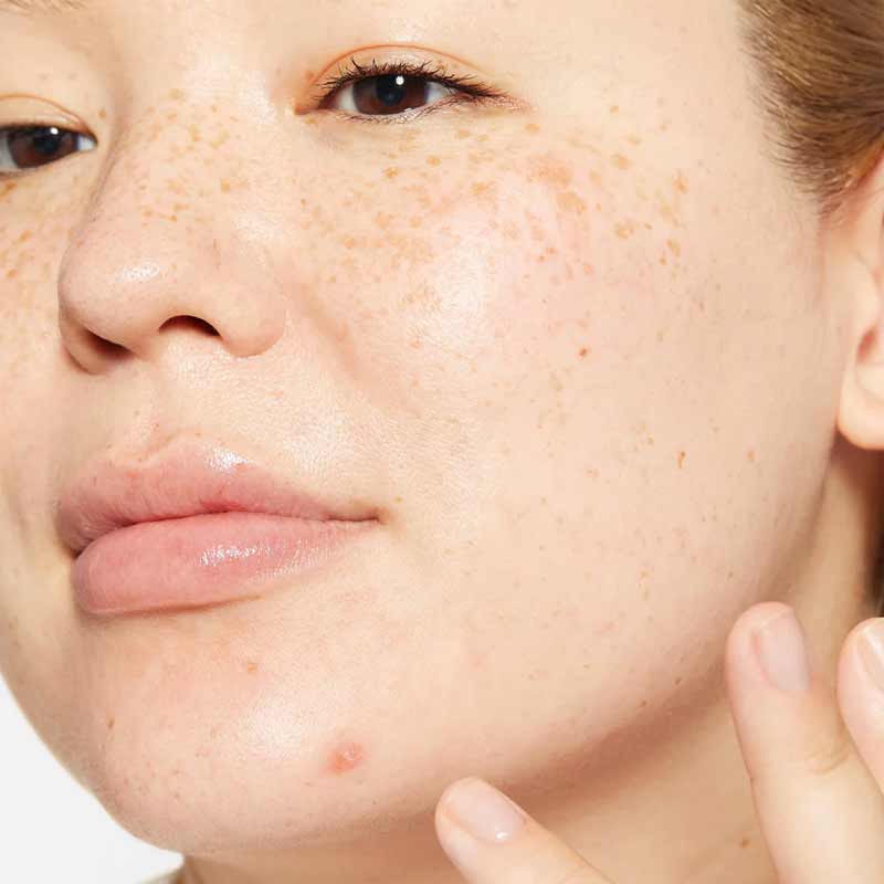 Dermalogica | Active | Clearing | Deep | Breakout | invisible | treatment | cools | soothes | liquid | patch | clear | prevent | breakouts | balance | microbiome | minimizing oil