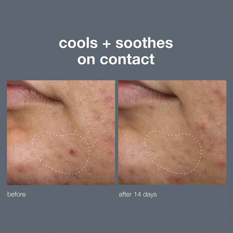 Dermalogica | Active | Clearing | Deep | Breakout | invisible | treatment | cools | soothes | liquid | patch | clear | prevent | breakouts | balance | microbiome | minimizing oil