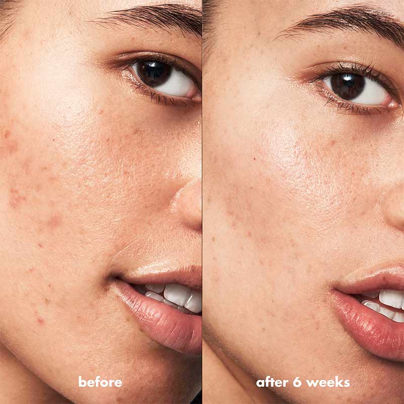 e.l.f. Blemish Breakthrough Acne Clarifying Cleanser | cleanser | tik tok skincare | elf cleanser | acne clarifying cleanser | skincare | elf skin | best elf products 