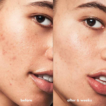 e.l.f. Blemish Breakthrough Acne Clarifying Cleanser | cleanser | tik tok skincare | elf cleanser | acne clarifying cleanser | skincare | elf skin | best elf products 
