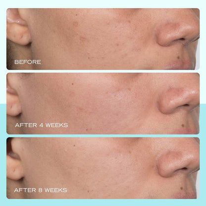 First Aid Beauty | Dark Spot Serum | Niacinamide | hydrating serum | targets dark spots | reduces sunspots | reduces hyperpigmentation | reduces discolouration | reduces post-acne marks | brighter skin tone | even skin tone | gentle formula | improves skin tone | smooth skin | healthy-looking skin