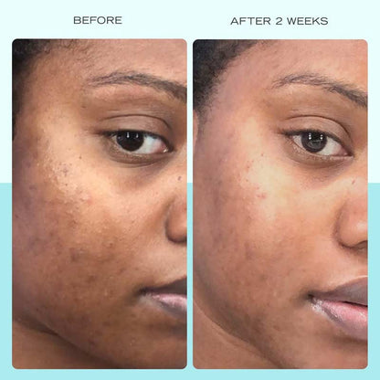 First Aid Beauty | Dark Spot Serum | Niacinamide | hydrating serum | targets dark spots | reduces sunspots | reduces hyperpigmentation | reduces discolouration | reduces post-acne marks | brighter skin tone | even skin tone | gentle formula | improves skin tone | smooth skin | healthy-looking skin
