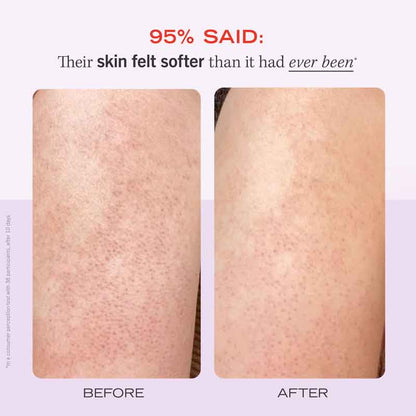 First Aid Beauty KP Bump Eraser Body Scrub, body scrub for soft skin, chicken skin, Keratosis Pilaris