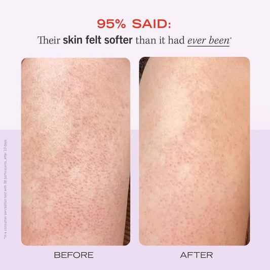 First Aid Beauty KP Bump Eraser Body Scrub, body scrub for soft skin, chicken skin, Keratosis Pilaris