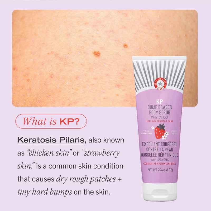 First Aid Beauty KP Bump Eraser Body Scrub, Keratosis Pilaris, Chicken Skin bumps, bumpy skin
