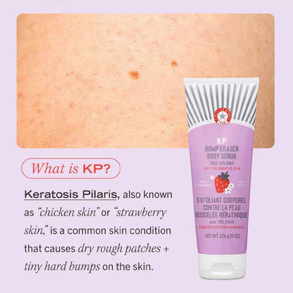 First Aid Beauty KP Bump Eraser Body Scrub, Keratosis Pilaris, Chicken Skin bumps, bumpy skin