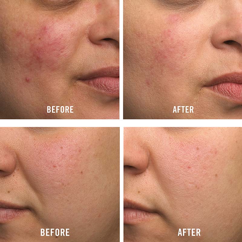 First Aid Beauty Ultra Repair Cream | before and after