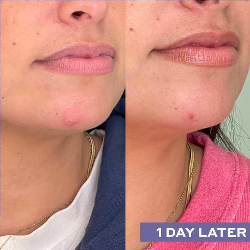 Mario Badescu Repairing Facial Spray With Hypochlorous Acid Before & After