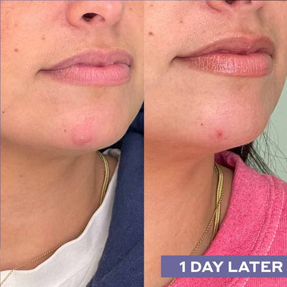 Mario Badescu Repairing Facial Spray With Hypochlorous Acid Before & After