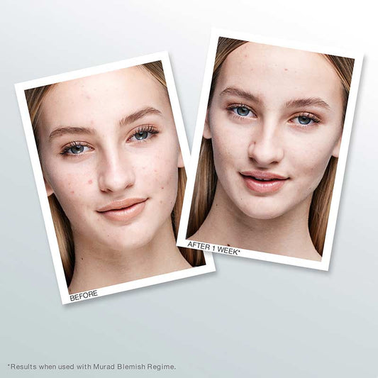 Murad Blemish Control Outsmart Blemish Clarifying Treatment | reduce acne