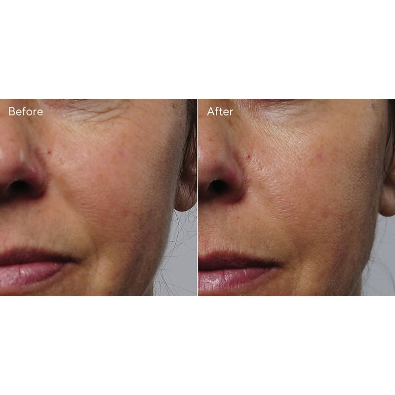 Murad Rapid Collegen Infusion | before and after | results