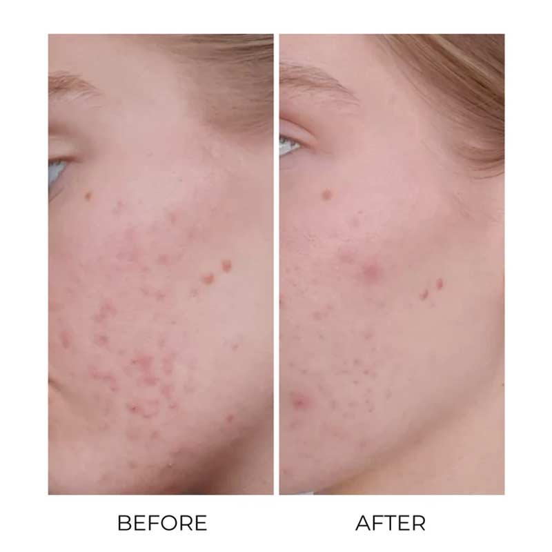 Oskia London | MSM Bio-Plus Supplements | Acne | Acne Scarring | Breakout Treatment