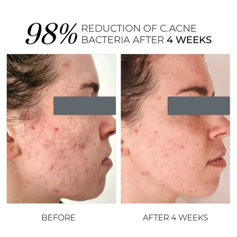 Oskia London | Violet Water D-Spot Clearing Blemish Treatment | Before & after | Reduces Blemishes | Acne