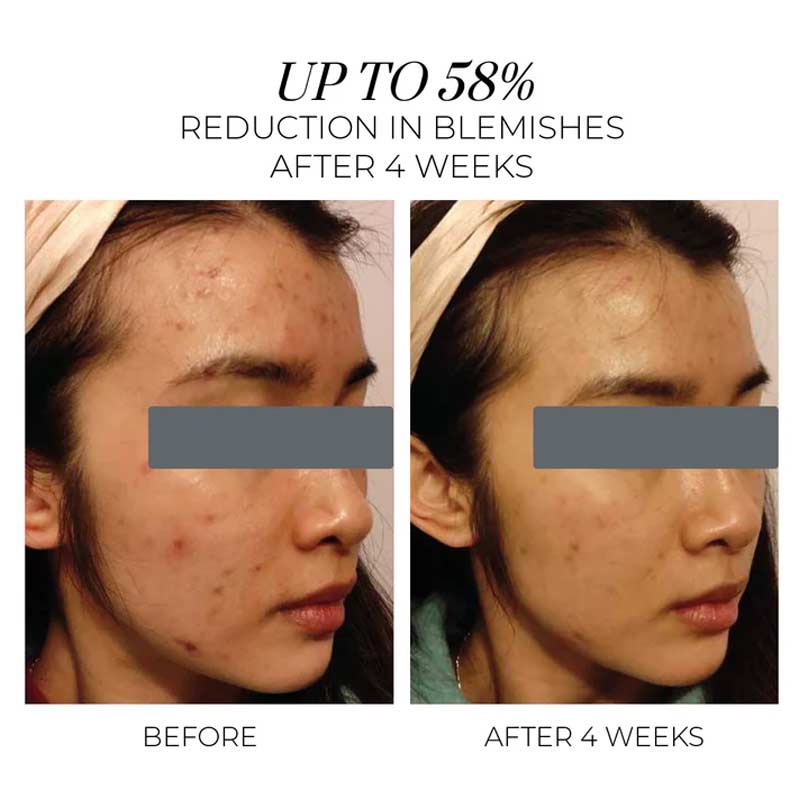 Oskia London | Violet Water Hydra-Gel Clarifying Daily Moisturiser | reduces blemishes | Facial Moisturiser | Before & After