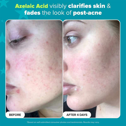 Paula's Choice Azelaic Acid Before and after picture