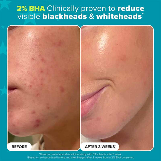 Paula's Choice 2% BHA Before and After