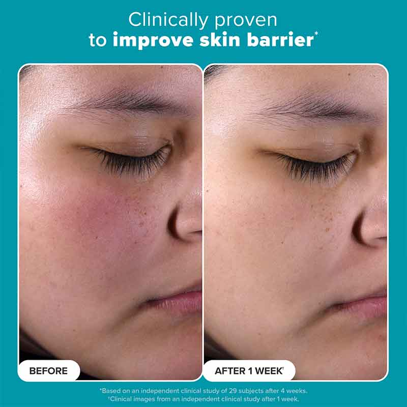 Paula's Choice BHA, salicylic acid toner, Paula's Choice acne