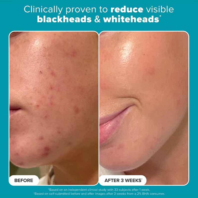 Paula's Choice Skin Perfecting 2% BHA Liquid Exfoliant, acne prone skin, skincare for acne scars