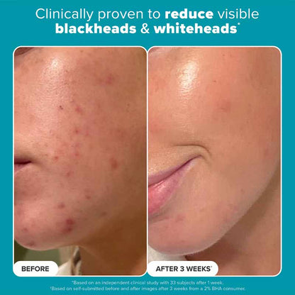 Paula's Choice Skin Perfecting 2% BHA Liquid Exfoliant, acne prone skin, skincare for acne scars