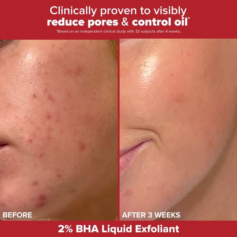Skincare Giftset, Gifts for Her, 2% BHA Liquid Exfoliant