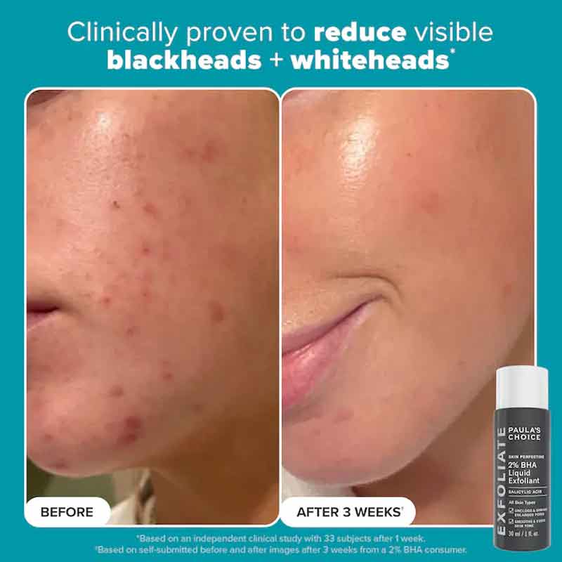Paula's Choice BHA Liquid Exfoliant, acne treatments, clogged pores, Paula's Choice Exfoliator