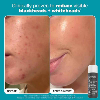 Paula's Choice BHA Liquid Exfoliant, acne treatments, clogged pores, Paula's Choice Exfoliator