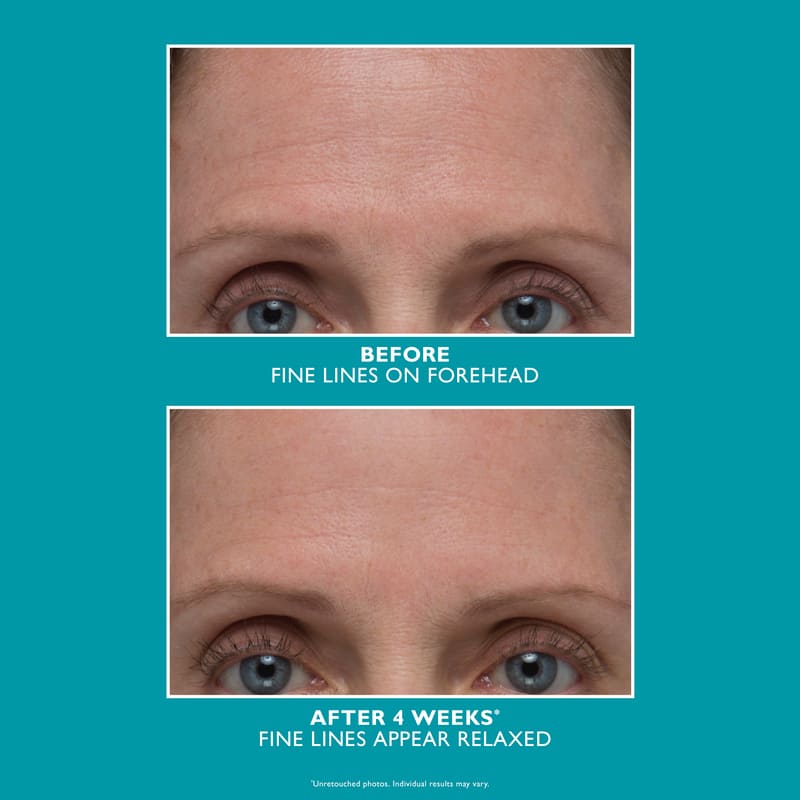 Peter Thomas Roth, Peter Thomas Roth Peptide Skinjection Amplified Wrinkle-Fix Serum, Reduce Fine Lines, Reduce Wrinkles