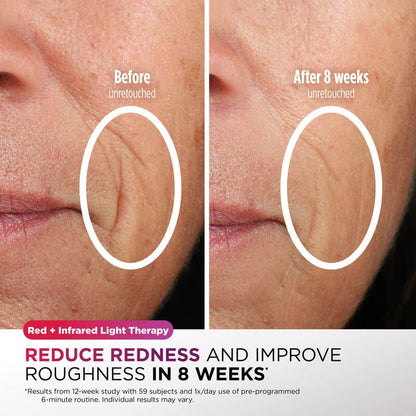 Shark CryoGlow Under-Eye Cooling + LED Face Mask reduces redness results