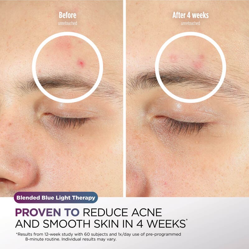 Shark CryoGlow Under-Eye Cooling + LED Face Mask reduces acne and smoothes skin