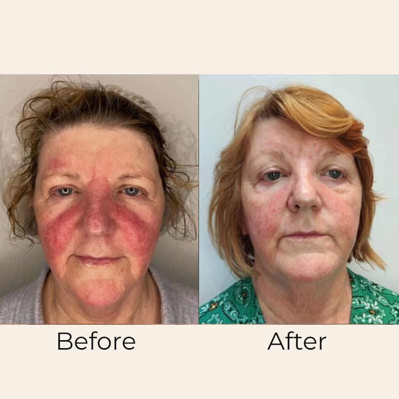 Skin Formulas, Skin Formulas Clear Skin Treatment Serum Before & After, skin redness
