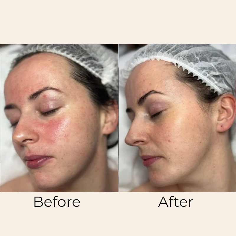 Skin Formulas, Skin Formulas Skin Mist Ceramide & Hyaluronic Before & After, soothing face mist, calming skincare