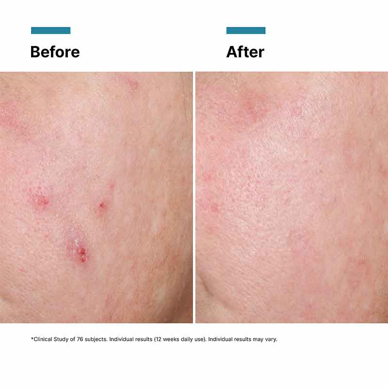 SkinCeuticals Advanced RGN-6 Before & After