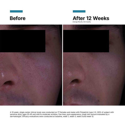 SkinCeuticals P-TIOX Anti-Wrinkle Cream Before & After