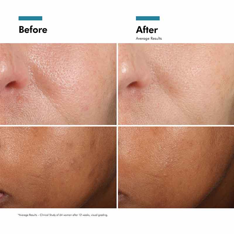 SkinCeuticals Phloretin CF Serum Before & After