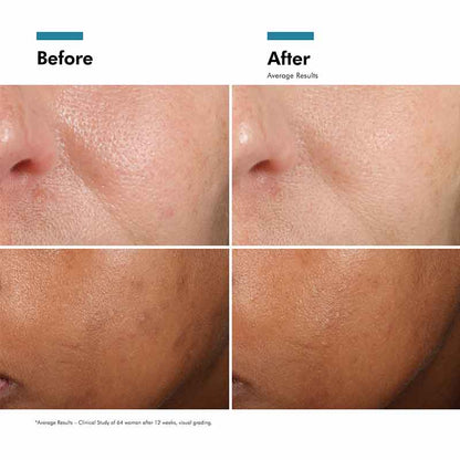 SkinCeuticals Phloretin CF Serum Before & After