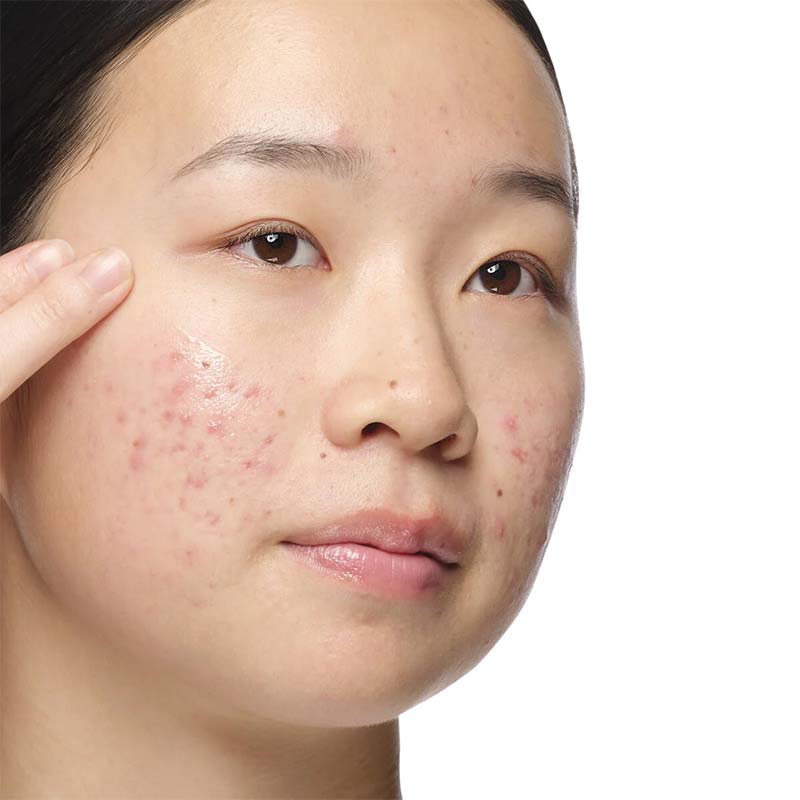 The Ordinary Aloe 2% + NAG 2% Solution | blemish prone skin serum | acne serum | skincare from the ordinary | The Ordinary | acne skincare | blemishes | redness | acne