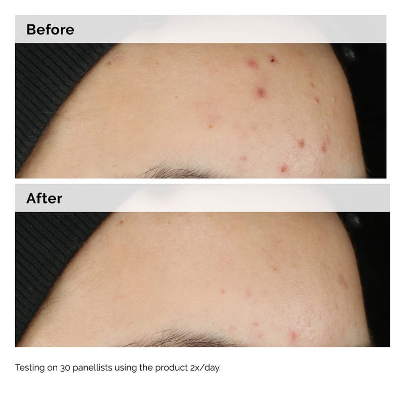 The Ordinary | Balancing & Clarifying Serum | Acne Prone Skin | Acne Treatments | Acne Scarring