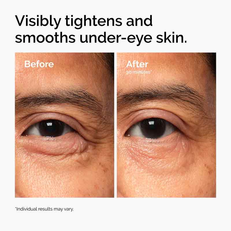 The Ordinary Lacto-PDRN 4% + B9 Lifting & Tightening Eye Cream Under Eye Bags Before & After