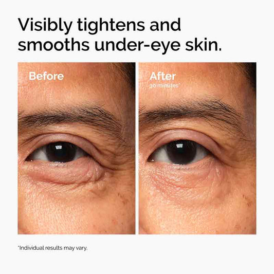 The Ordinary Lacto-PDRN 4% + B9 Lifting & Tightening Eye Cream Under Eye Bags Before & After