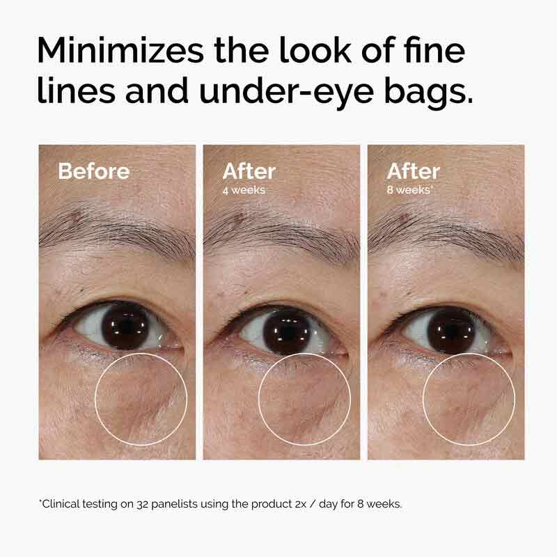 The Ordinary Lacto-PDRN 4% + B9 Lifting & Tightening Eye Cream Before & After Under Eye Bags