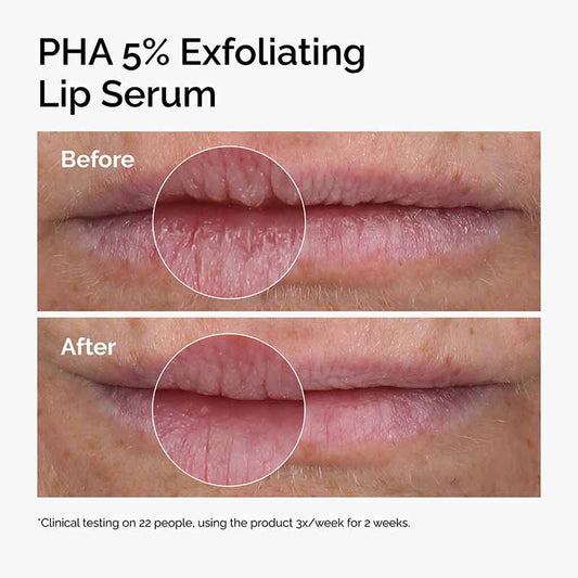 The Ordinary PHA 5% Exfoliating Lip Serum Before and After image