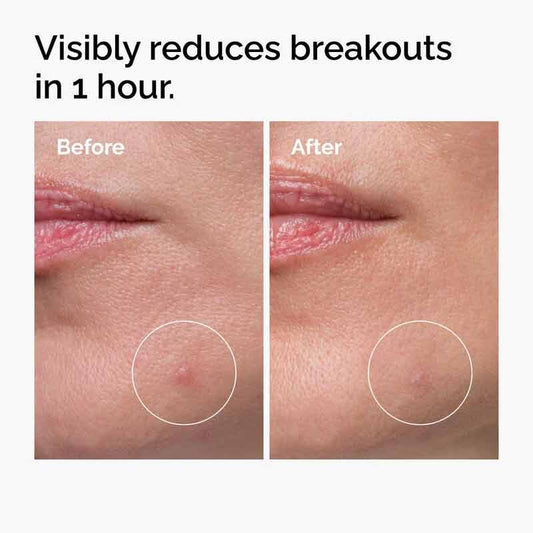 The Ordinary Sulfur 10% Powder to Cream Concentrate Before and After of breakout