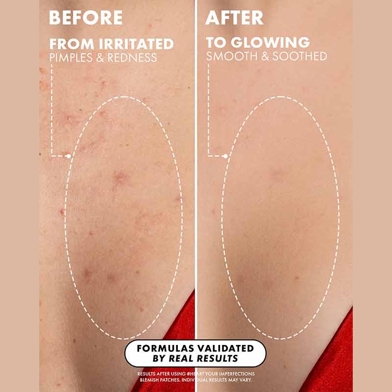 Truly Beauty Heart Your Imperfections Patches Before & After