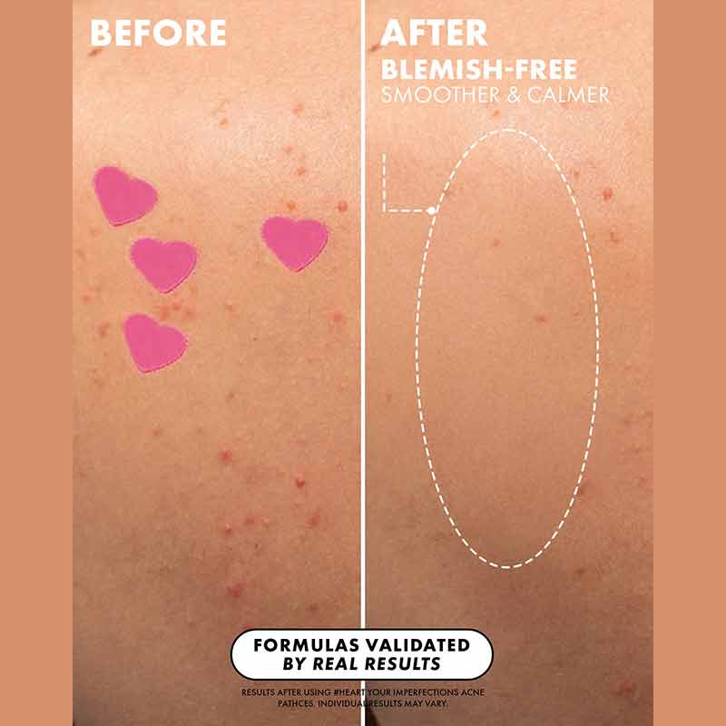 Truly Beauty Heart Your Imperfections Patches Before & After