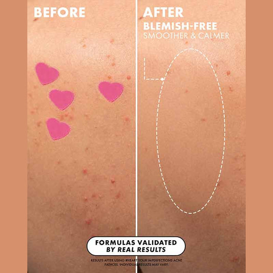 Truly Beauty Heart Your Imperfections Patches Before & After