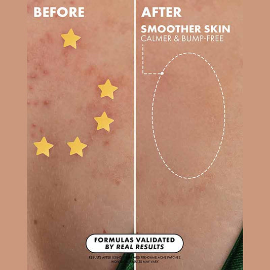 Truly Beauty Stars Scars Blemish Patches Before & After