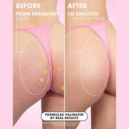 Truly Beauty Stars Scars Blemish Patches Before & After for back & bum acne